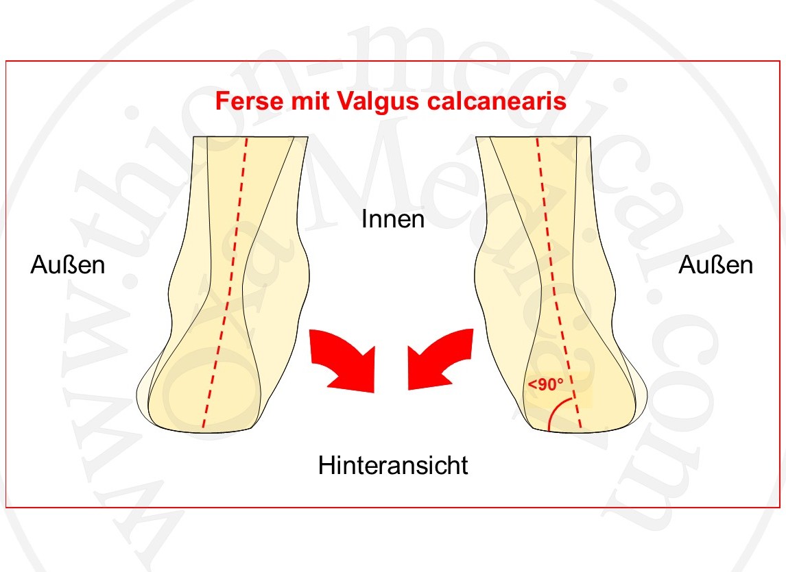 Schema einer Ferse mit Kalkaneusvalgus